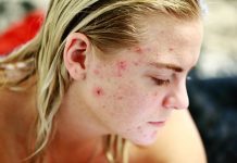 Les actions à adopter face à l’allergie alimentaire