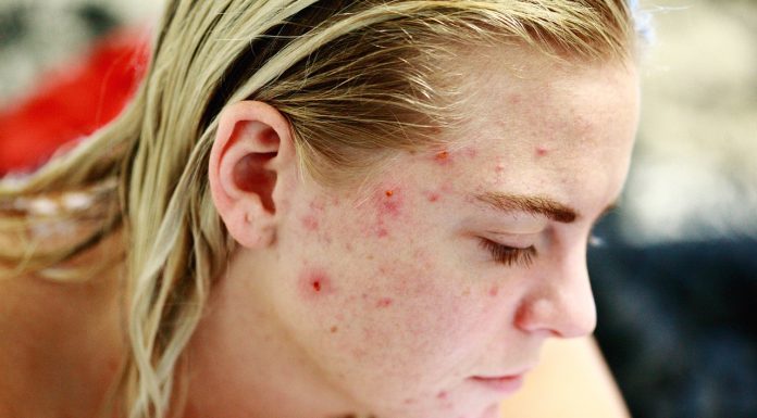 Les actions à adopter face à l’allergie alimentaire