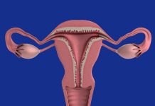 Ce qu’il y a à savoir sur l’endométriose
