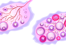 Les principales raisons provoquant la stérilité chez les femmes